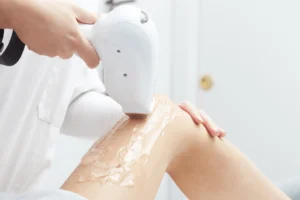 epilazione laser diodo